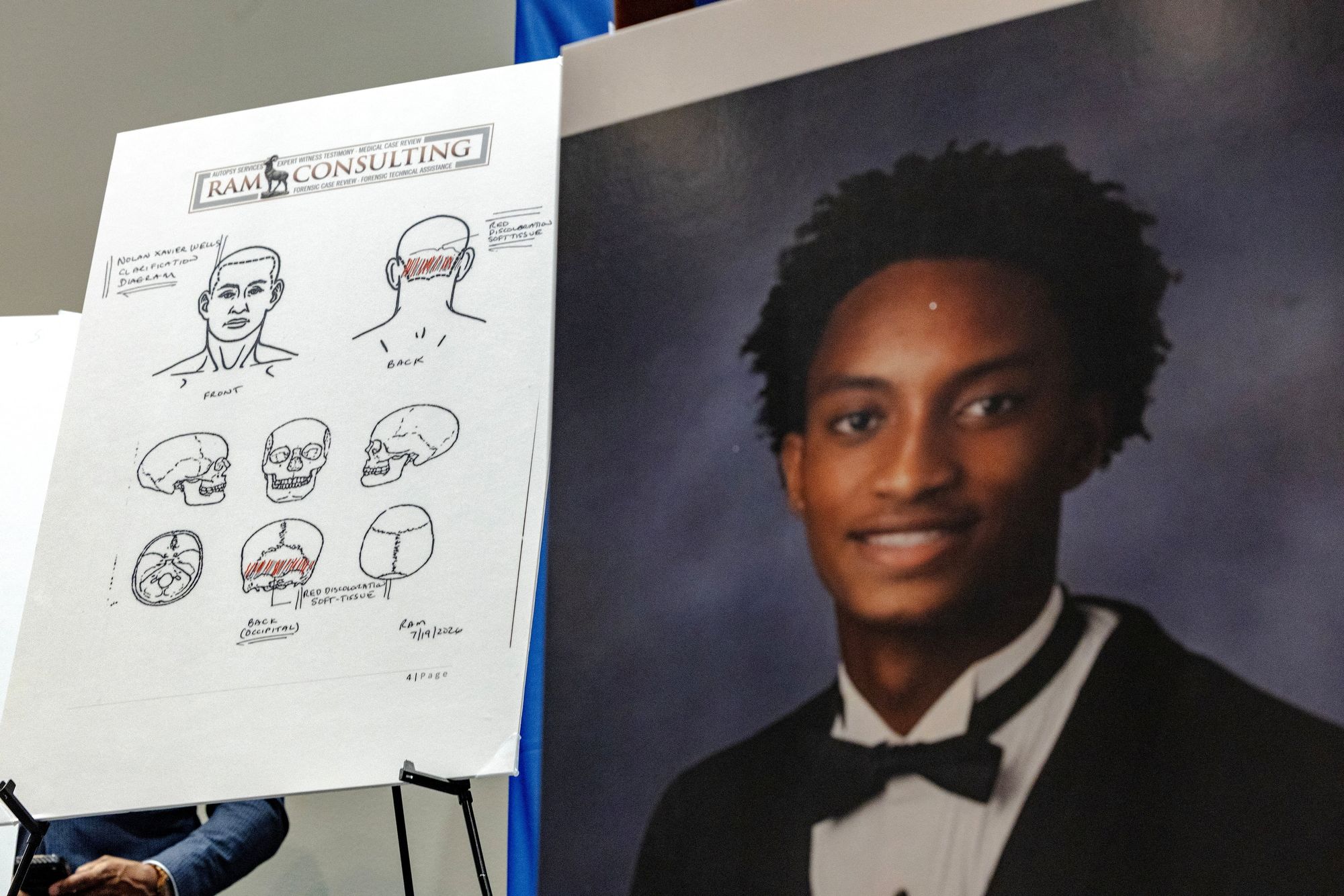 <i>Jim Vondruska/Reuters via CNN Newsource</i><br/>Diagrams depicting preliminary findings from Nolan Wells' independent autopsy are shown during a press conference Wednesday.
