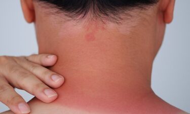 Sunburn relief: Dermatologist-approved methods that actually work