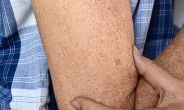 Sunspots vs. freckles: How to tell them apart