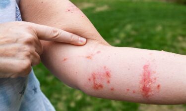 6 ways to get rid of poison ivy rash symptoms fast