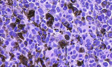 A micrograph shows malignant melanoma. Merck and Moderna said their personalized mRNA vaccine combined ​with an immunotherapy drug reduced melanoma skin ‌cancer recurrence in a study.