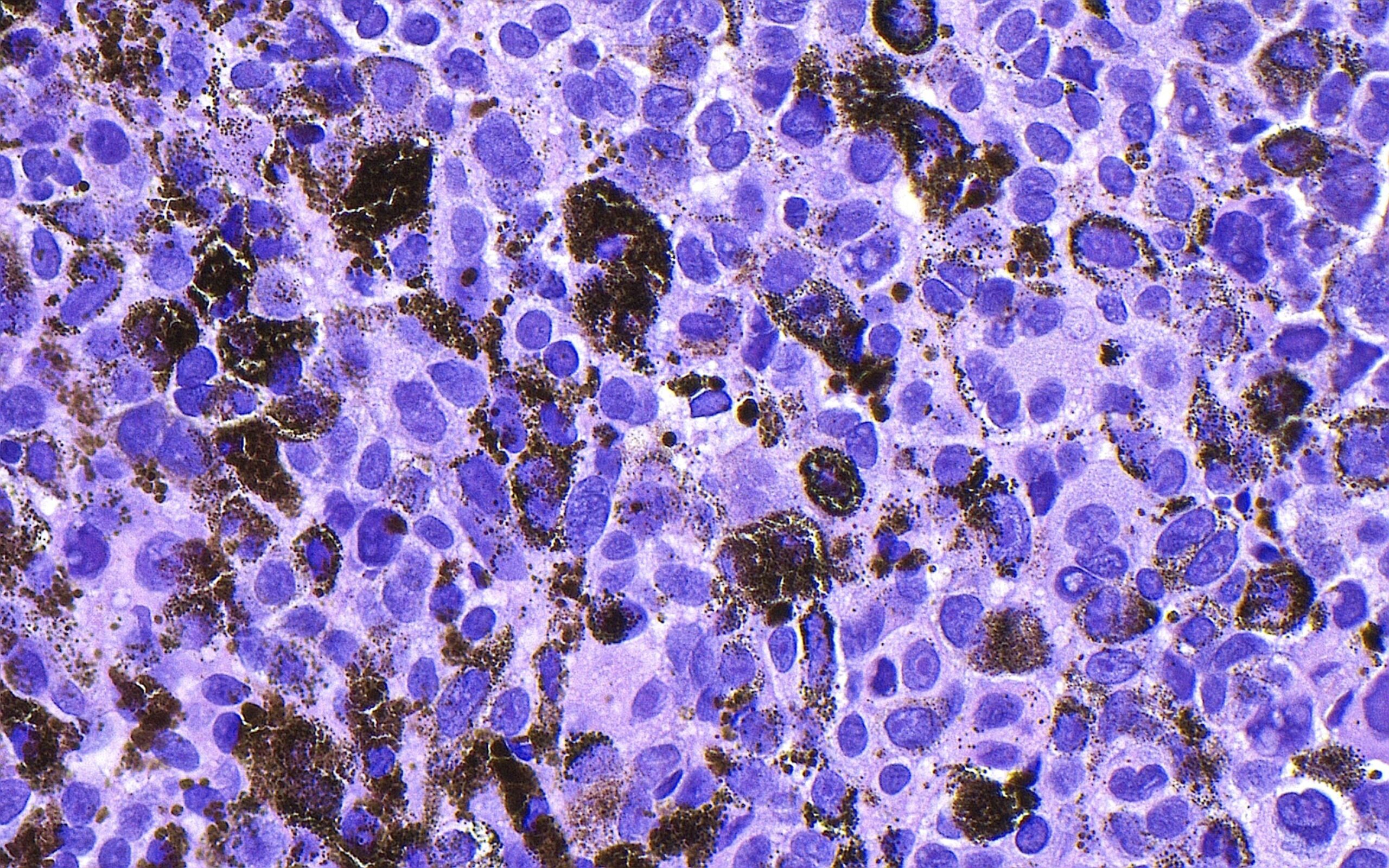 <i>Ziad M. El-Zaatari/Science Photo Library/Getty Images via CNN Newsource</i><br/>A micrograph shows malignant melanoma. Merck and Moderna said their personalized mRNA vaccine combined ​with an immunotherapy drug reduced melanoma skin ‌cancer recurrence in a study.
