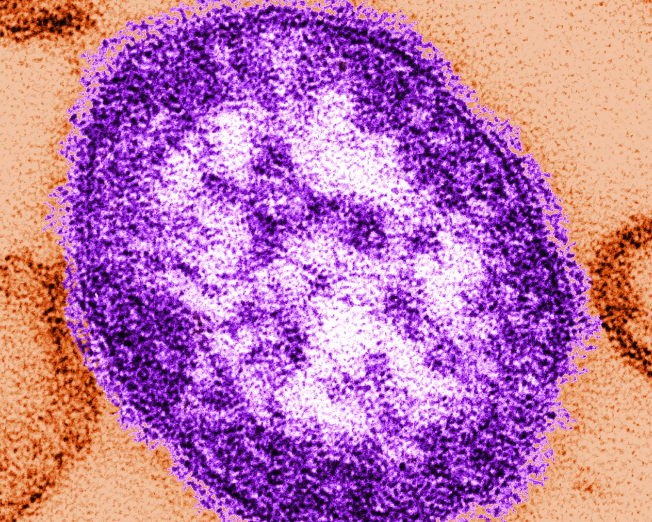 <i>Callista Images/Image Source/Getty Images via CNN Newsource</i><br/>Pennsylvania reported a fifth death related to measles amid an ongoing outbreak.