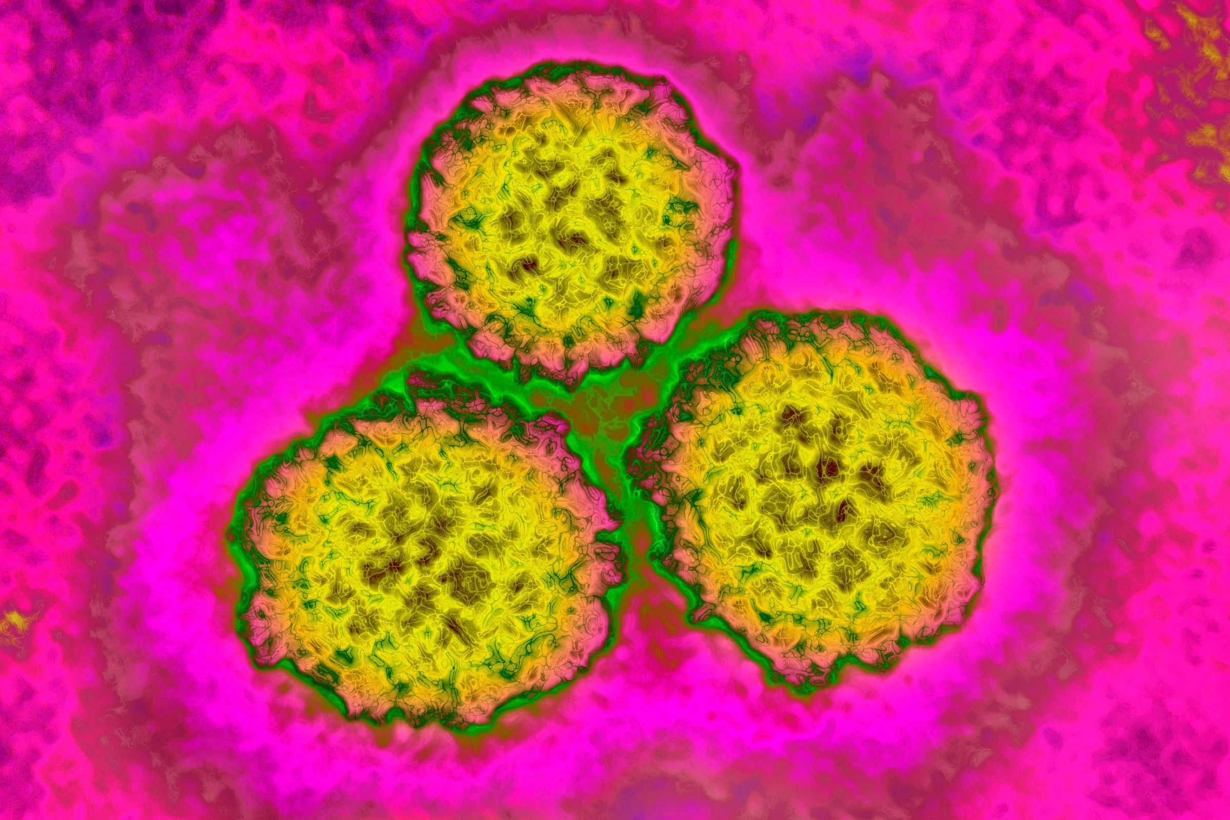 <i>BSIP/Universal Images Group/Getty Images via CNN Newsource</i><br/>Human papilloma virus or HPV is one of several infections that scientists connected to about 2.3 million new cancer cases globally in 2024